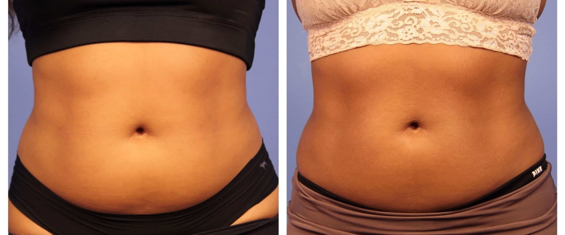 Does cool coolsculpting really work?