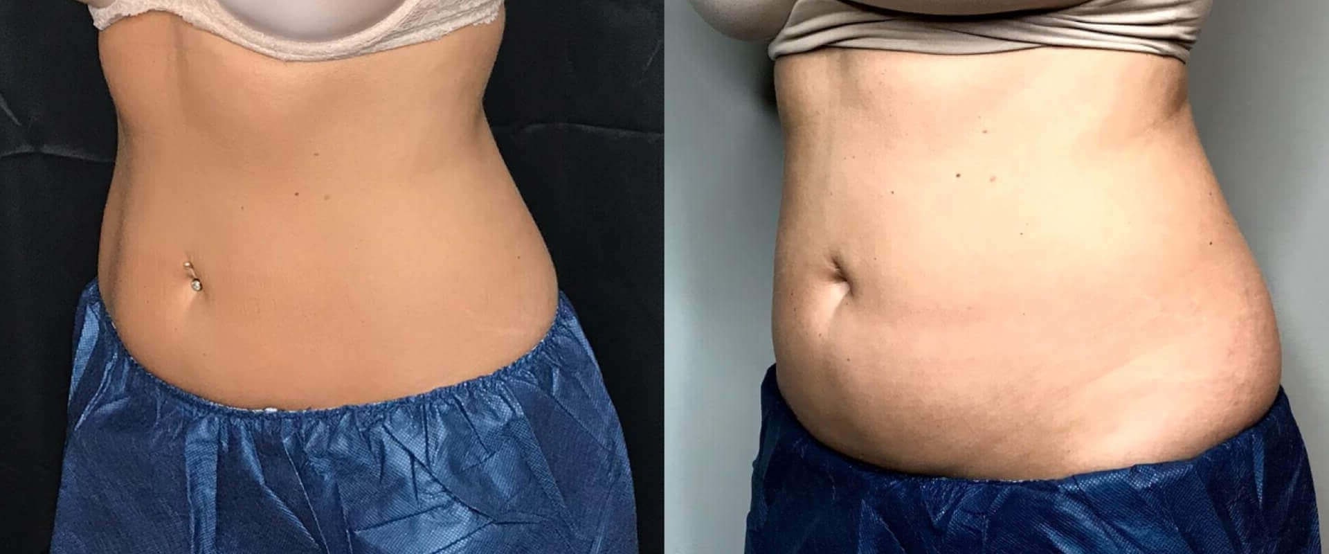 how-long-does-it-take-for-coolsculpting-to-show-results