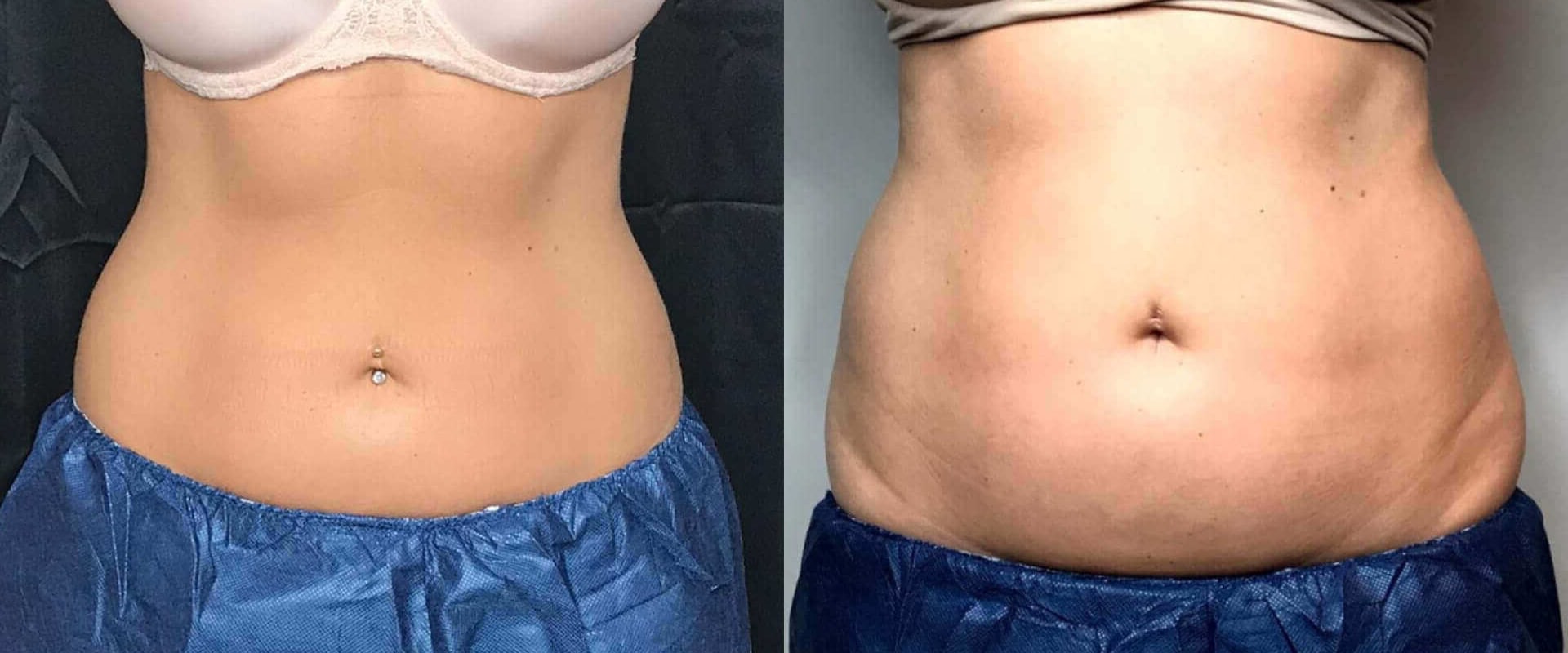 How long do coolsculpting results last?