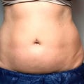 Coolsculpting what to expect?
