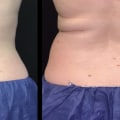 How fast does fat come back after coolsculpting?