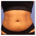 Why am i not seeing results from coolsculpting?