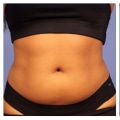 What coolsculpting does?