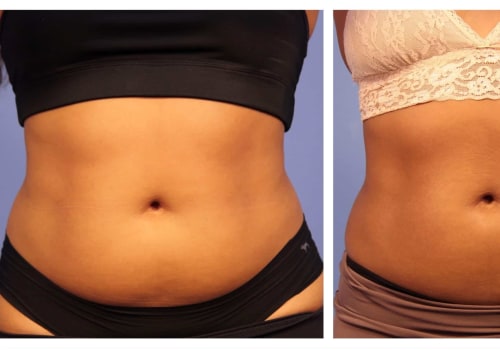 Where is coolsculpting located?